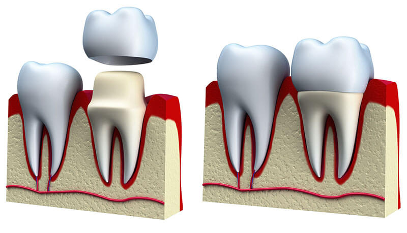 dental crown treatment in FLOSS Dental - Houston Midtown