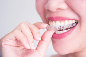invisalign-invisible-braces