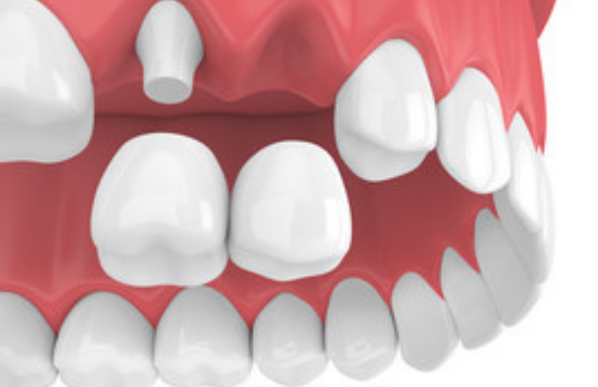 What Do You Need To Know About Dental Crowns? FLOSS Dental Houston Midtown