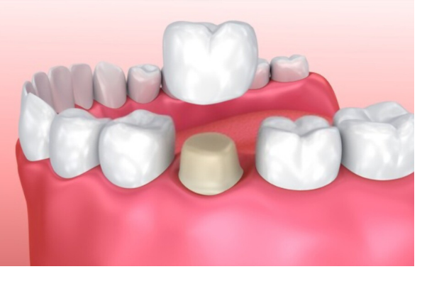 What You Should Know Before Getting a Dental Crown ?