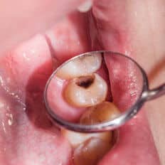 img-Large-Cavities img-Large-Cavities