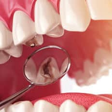 img-Tooth-Abscess img-Tooth-Abscess