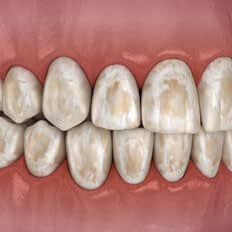 img-Tooth-Damage-Associated-With-Bruxism