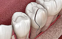 img-Tooth-Repair-And-Replacement