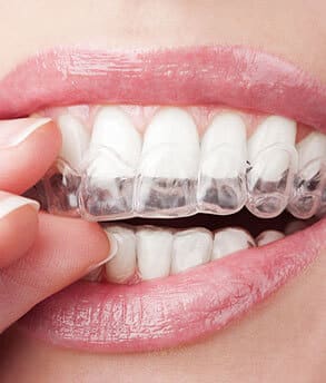 img-What-Is-Invisalign