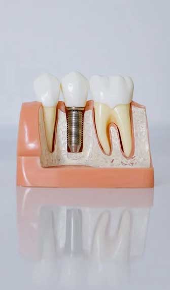 dental-implant-img dental-implant-img