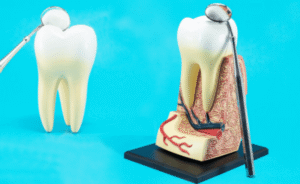 root-canal