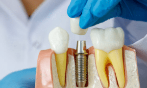 Dental Implant Midtown