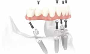 All-On-Four-Dental-Implants-Should-Be-Considered-by-Denture-Wearers