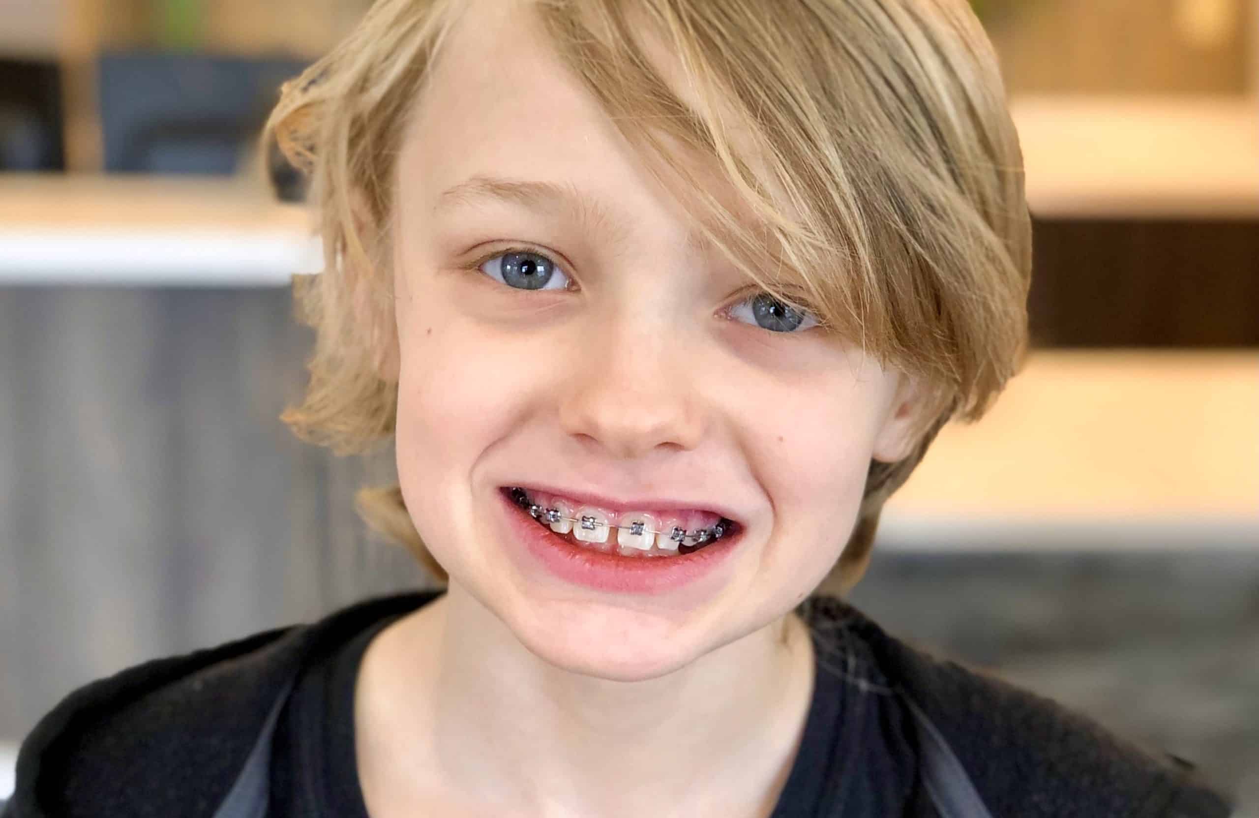 Best-Age-To-Get-Braces