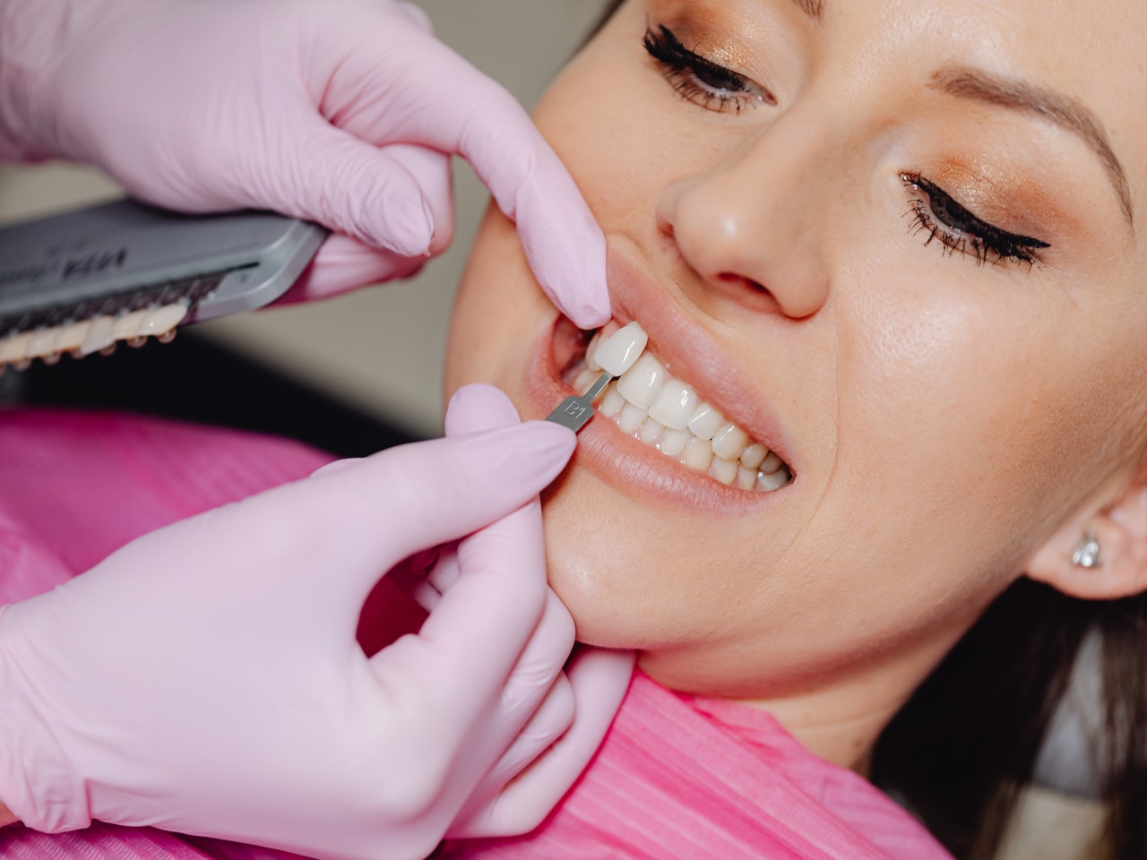 Veneers vs. Crowns Which is the Best Option for You?