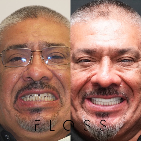 before_after_10