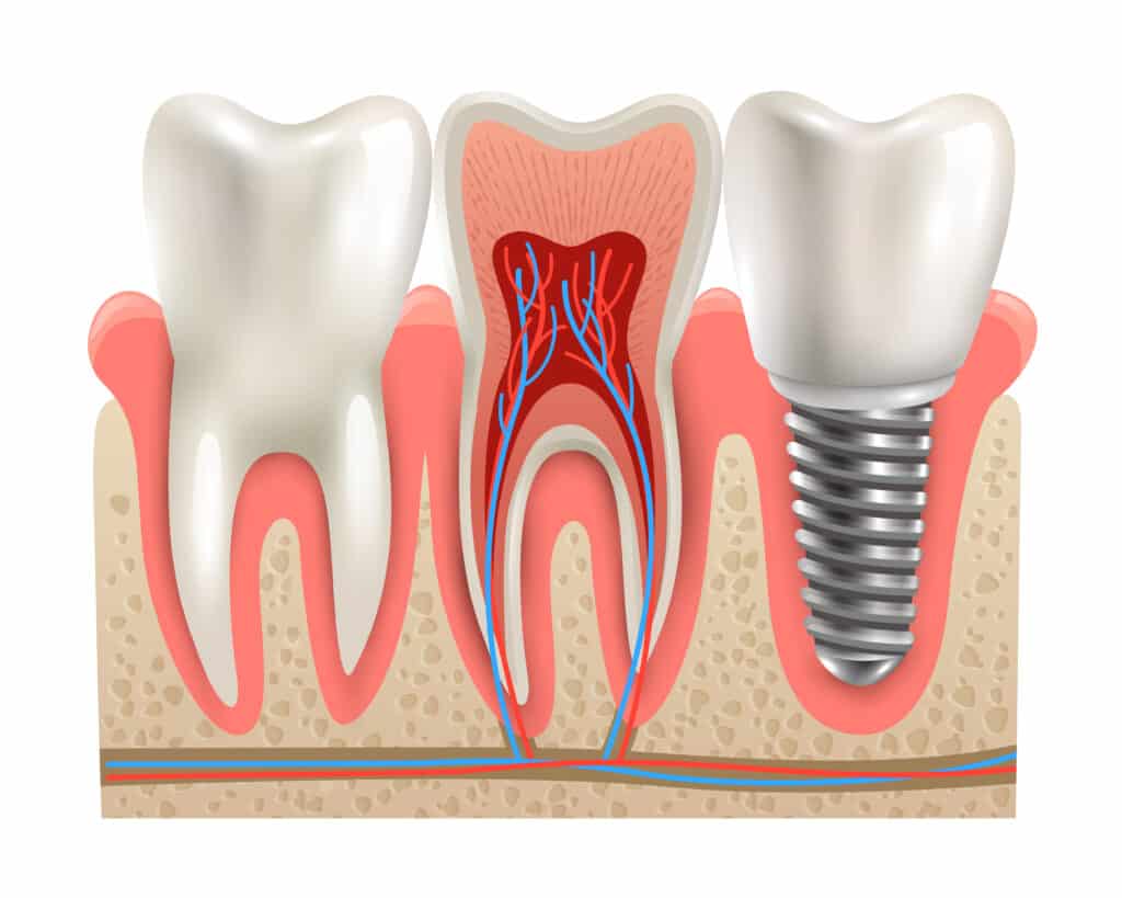 root canal therapry in houston tx floss dental of houston midtown