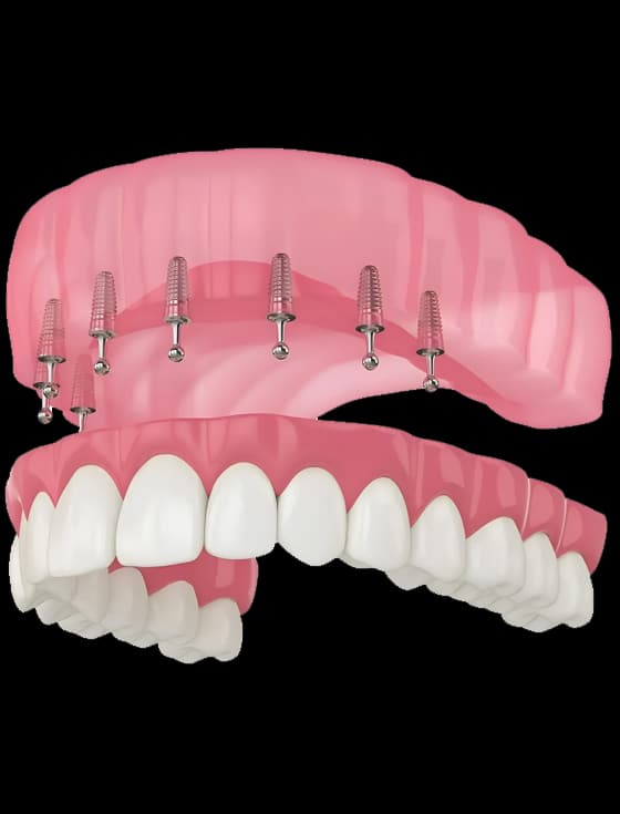 img-What Are Snap-In Implant Dentures