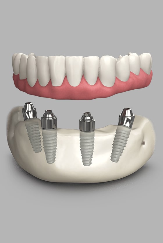 img-What are All-On-X Implants