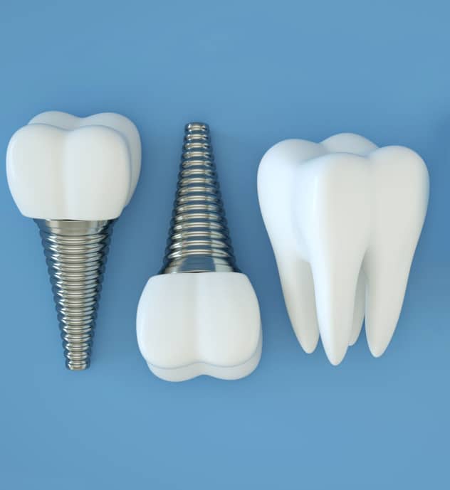img-What are Single Tooth Implants & Bridges