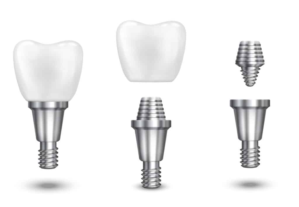 dental implant in houston tx floss dental of houston midtown