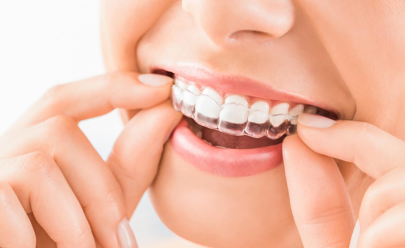 invisalign in houston tx, floss dental of houston midtown invisalign in houston tx, floss dental of houston midtown