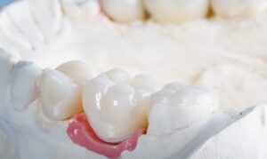 dental crowns in houston tx