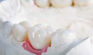 Dental Crown in Houston, TX