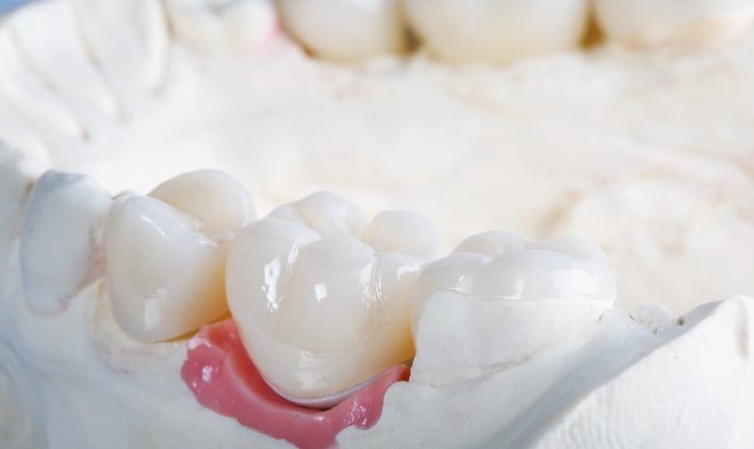 Factors Behind Longevity And Maintenance Of Dental Crowns