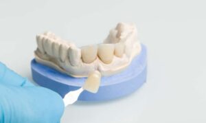 Dental Veneers in Houston TX