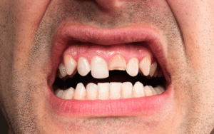First Aid For Teeth Injuries