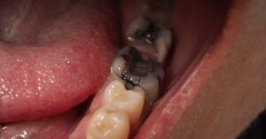 is a black tooth an emergency