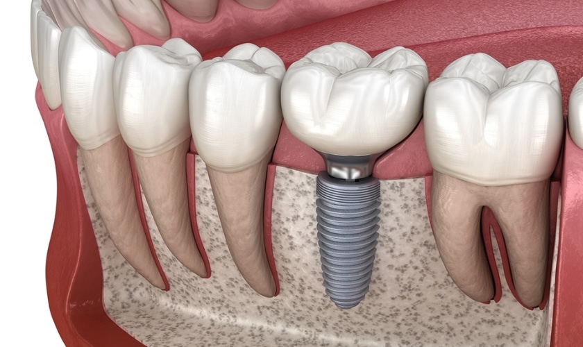 Dental implant model showing the implant post, abutment, and crown